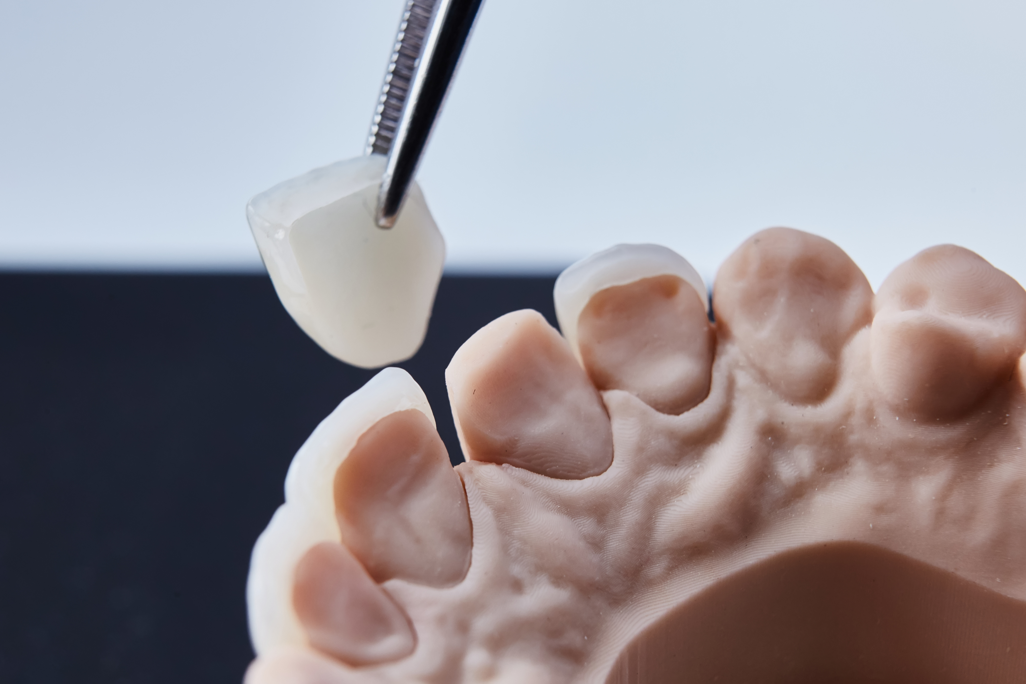 Pinzette hält Zahn an einen Zahnabdruck im Labor